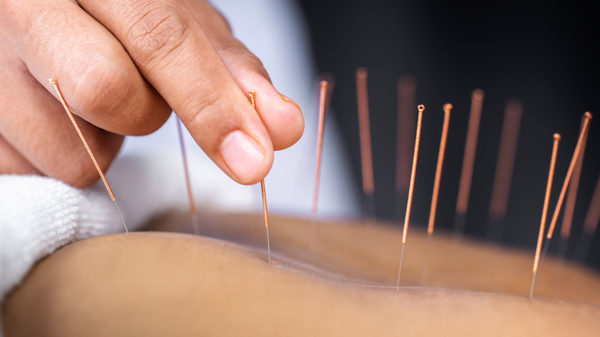 An acupuncturist's hand gently inserting a needle into a patient