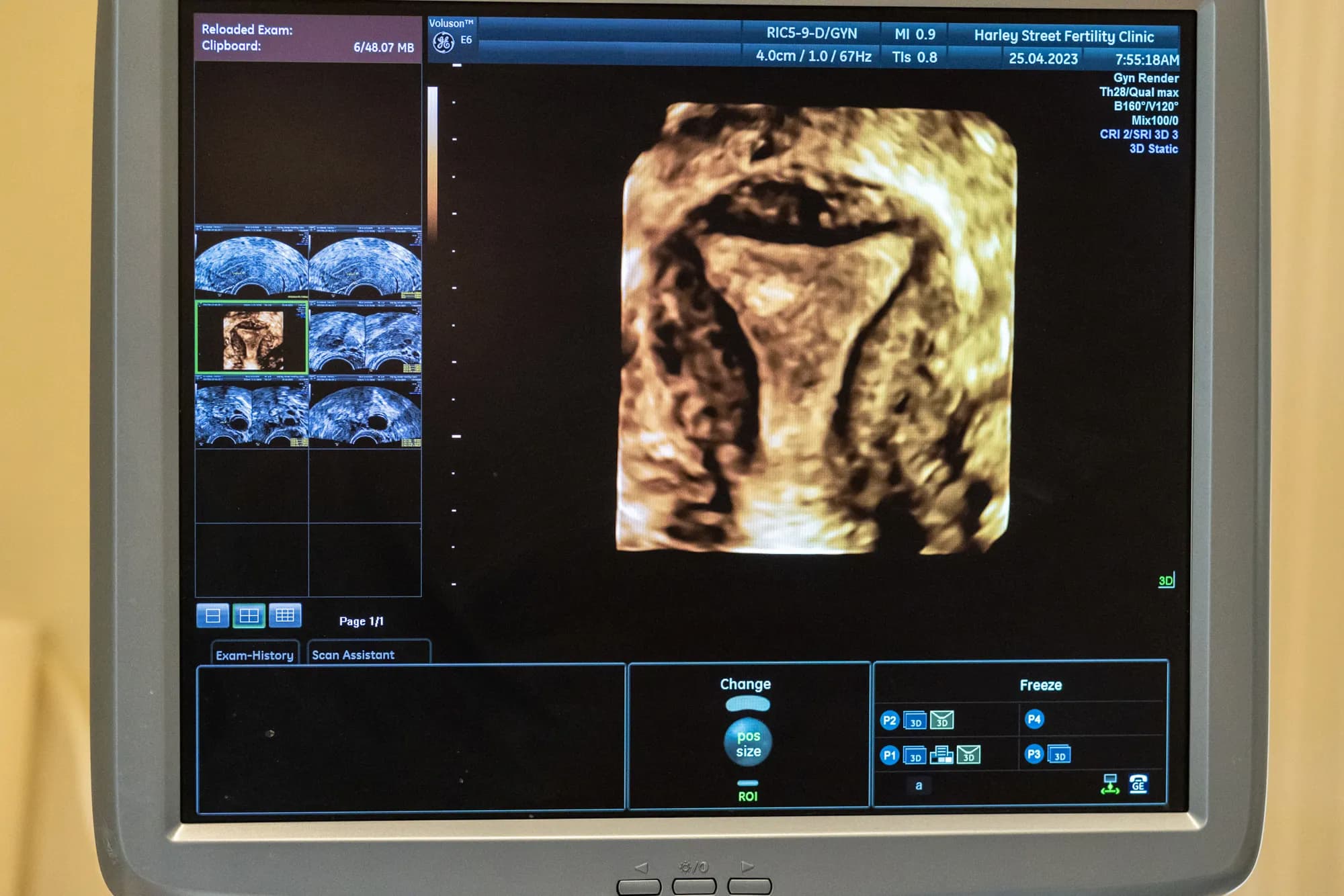 Scan of uterus, computer screen