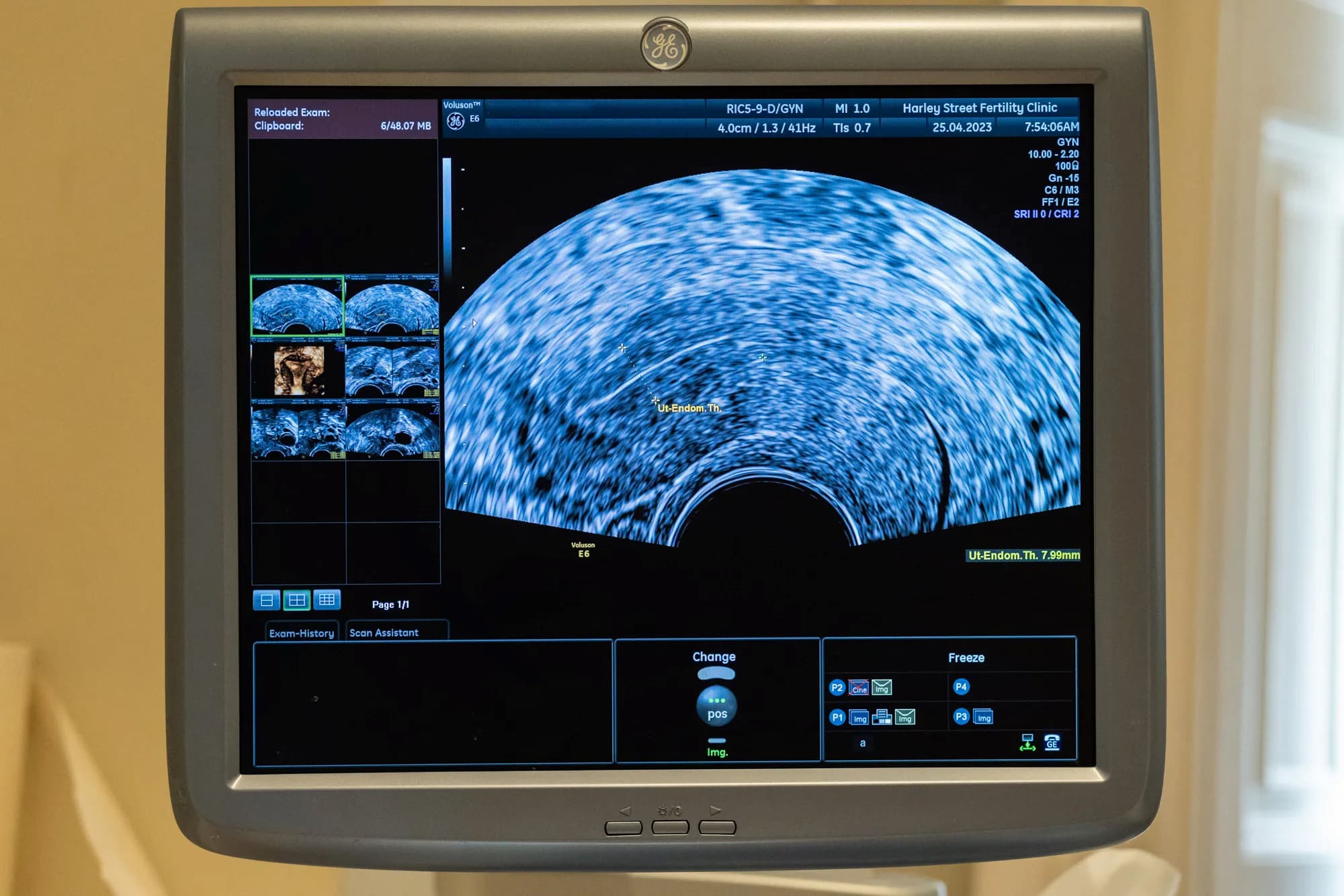Uterine scan